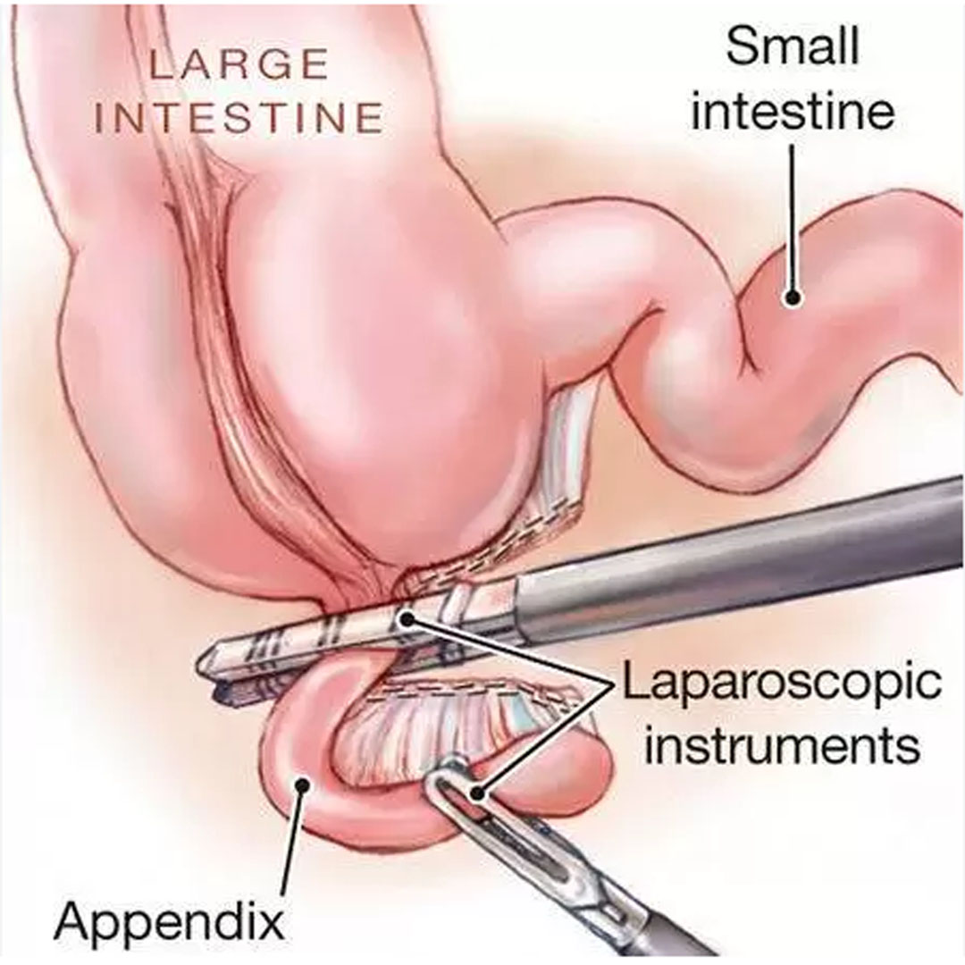 Appendix Surgery