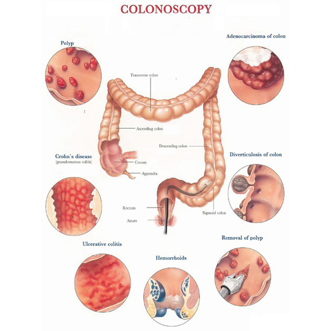 Appendix Surgery
