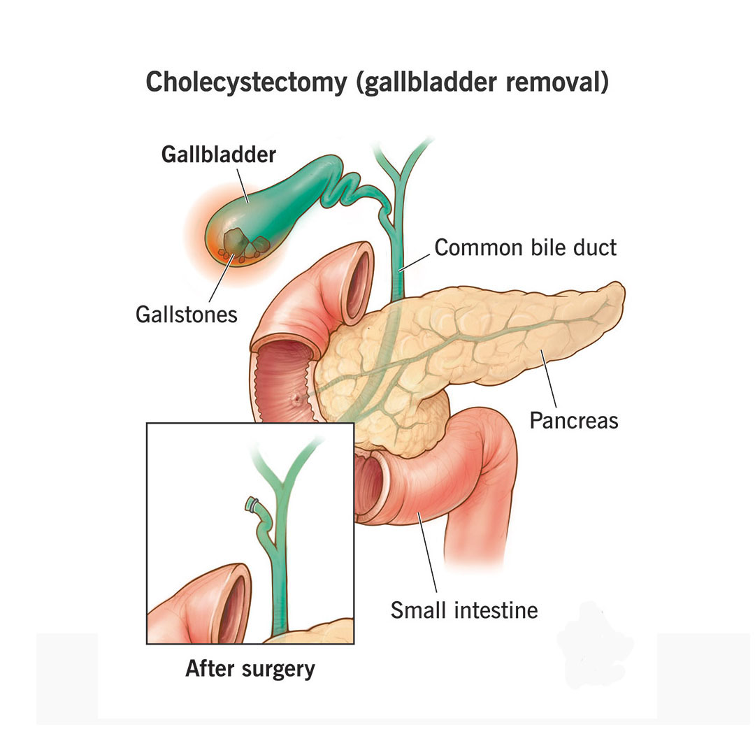 Appendix Surgery