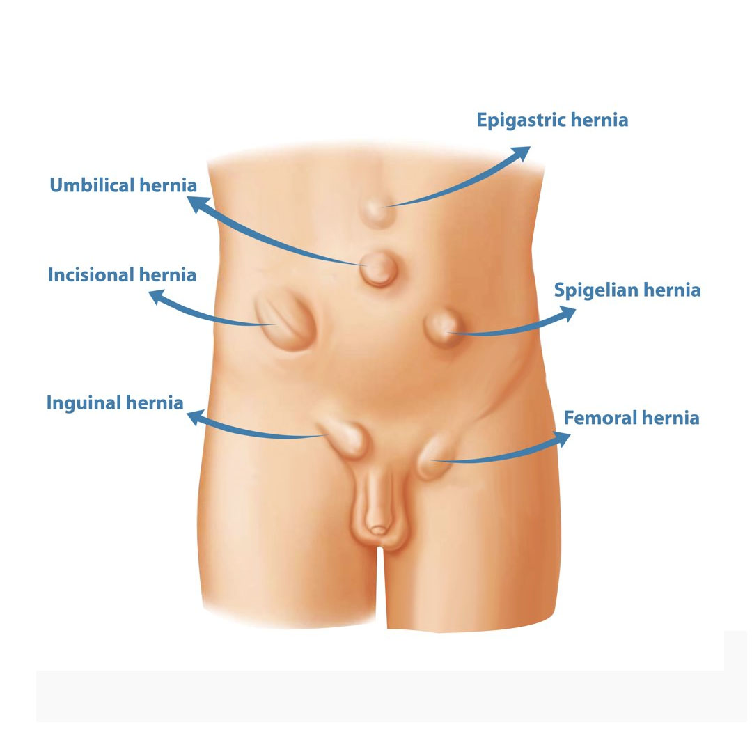 Appendix Surgery