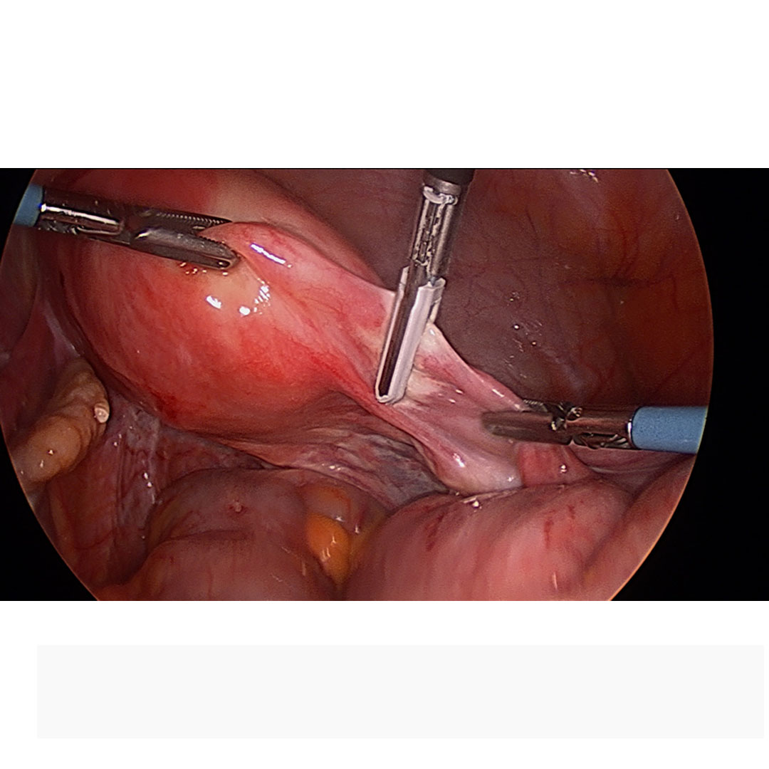 Appendix Surgery