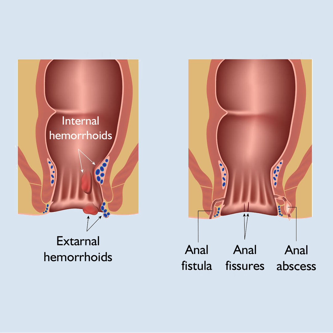 Appendix Surgery